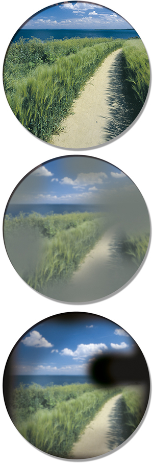 8686609GEM_KUNERT_Leistungen_Glaukom Gesichtsfeldeinschränkung